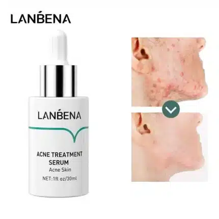 Lanbena Acne Treatment Serum - 15ml